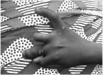 Deformed Hand Back BW