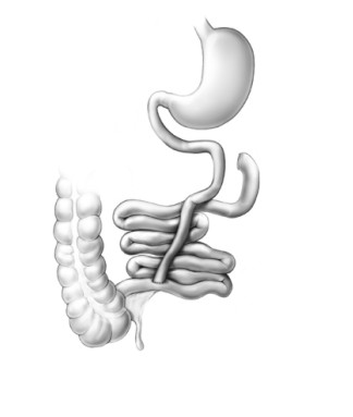 Jejuno-Ileal Bypass